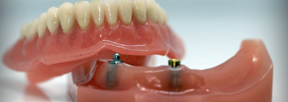 Prótesis dentales en Palma de Mallorca CAS Dental Prótesis dentales en Palma de Mallorca CAS Dental